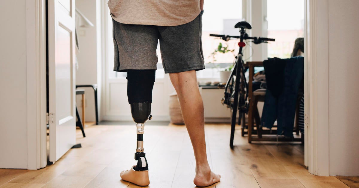 The Shocking Truth About Prosthetic Limb Coverage: A Fight for Access and Fairness